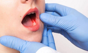 Oral-Cancer-Treatment.jpg